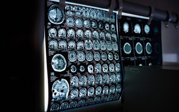 Viena klaida gali kainuoti sveikatą: šis kasdienis įprotis gali pristabdyti Alzheimerio simptomus