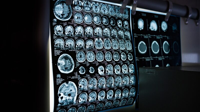 Viena klaida gali kainuoti sveikatą: šis kasdienis įprotis gali pristabdyti Alzheimerio simptomus