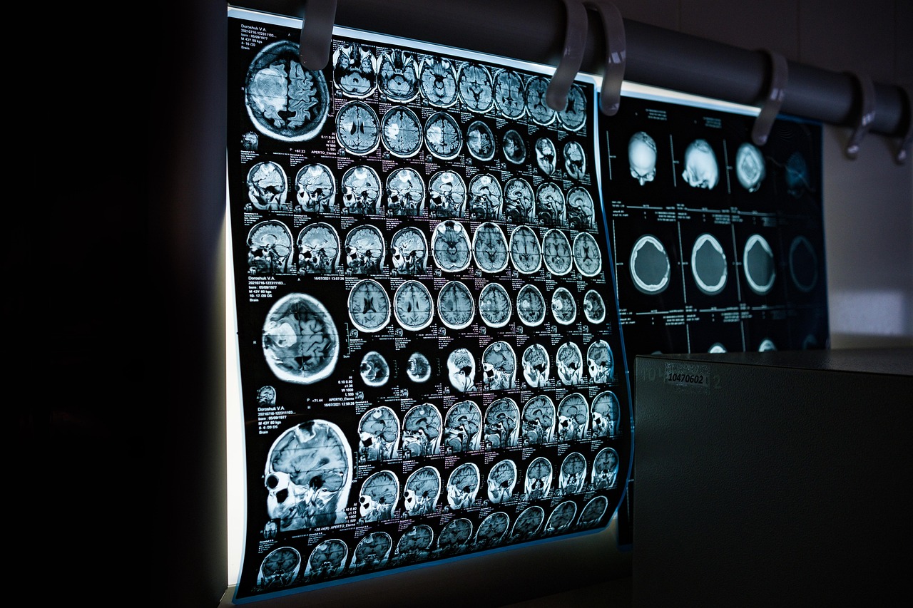Viena klaida gali kainuoti sveikatą: šis kasdienis įprotis gali pristabdyti Alzheimerio simptomus