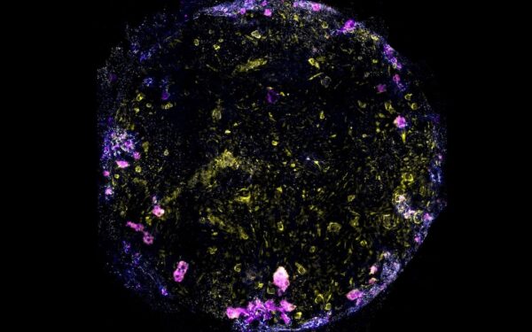 Privertė kvėpuoti dirbtinius plaučius ir tyčia užkrėtė mirtina tuberkulioze, štai kas nutiko vėliau