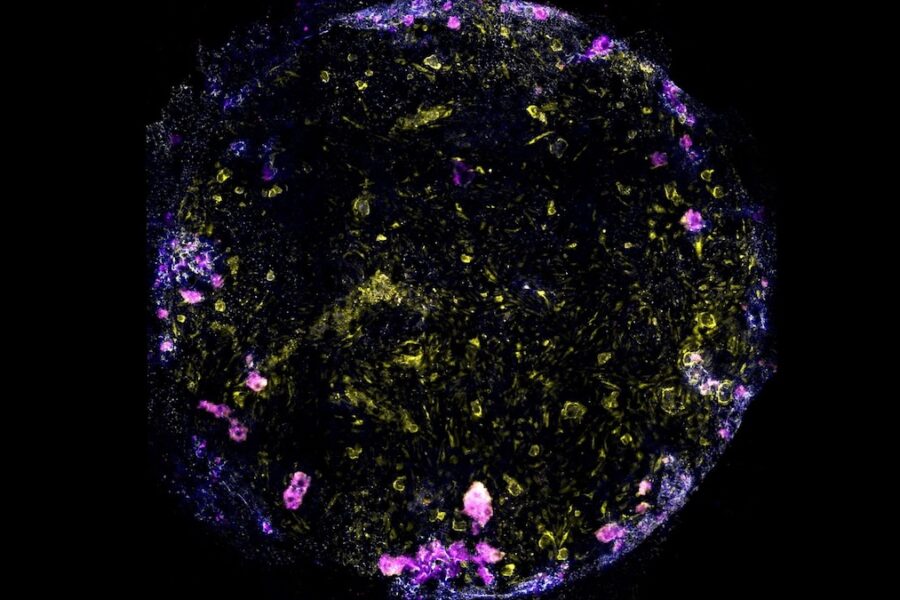 Privertė kvėpuoti dirbtinius plaučius ir tyčia užkrėtė mirtina tuberkulioze, štai kas nutiko vėliau