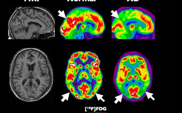 Mokslininkai šokiravo pasaulį: atskleidė Alzheimerio baltymų disbalanso valdymo mechanizmą