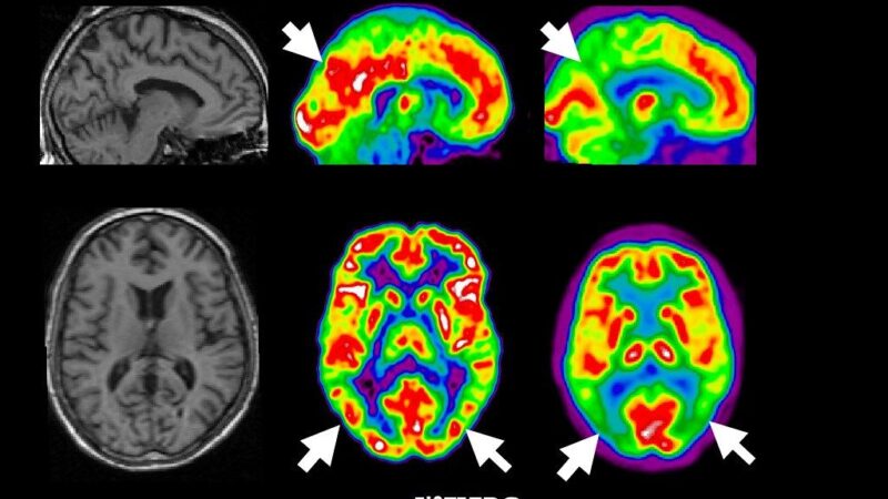 Mokslininkai šokiravo pasaulį: atskleidė Alzheimerio baltymų disbalanso valdymo mechanizmą