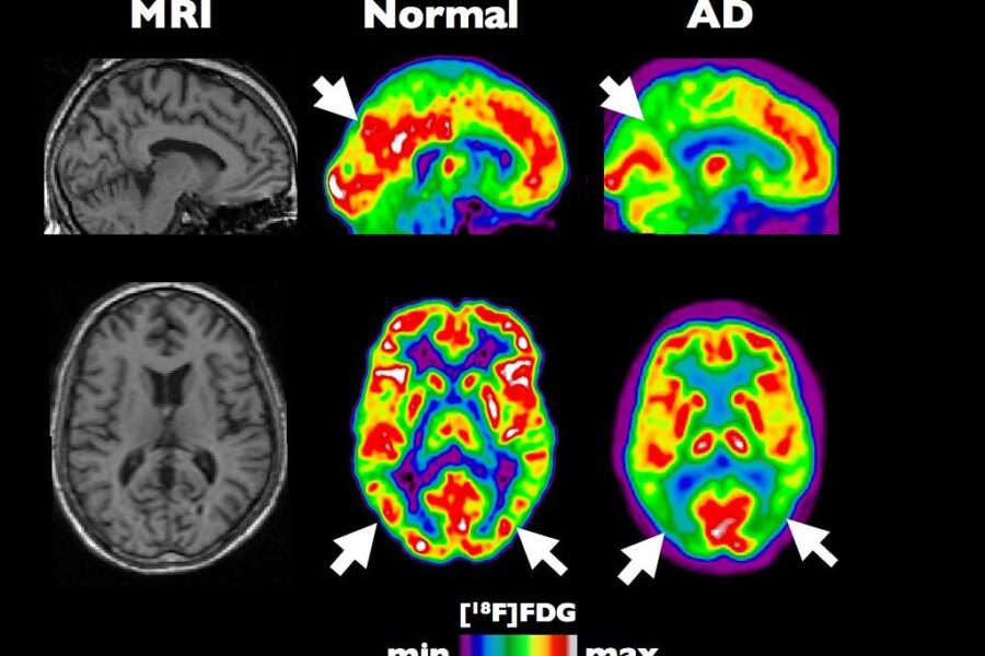 Mokslininkai šokiravo pasaulį: atskleidė Alzheimerio baltymų disbalanso valdymo mechanizmą