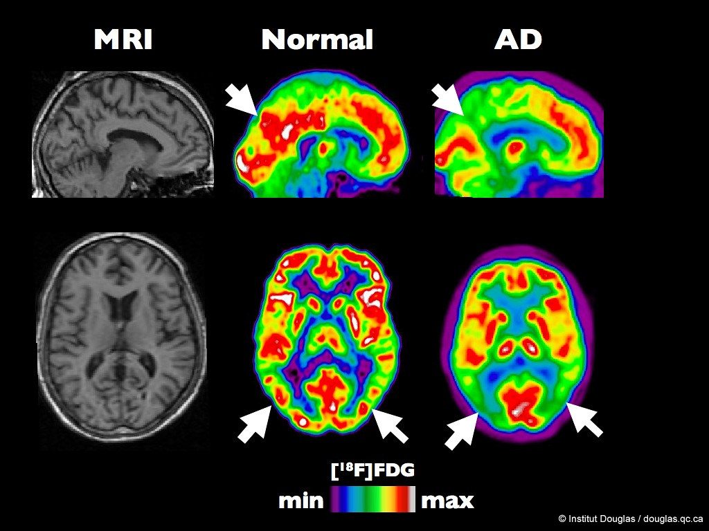 Mokslininkai šokiravo pasaulį: atskleidė Alzheimerio baltymų disbalanso valdymo mechanizmą