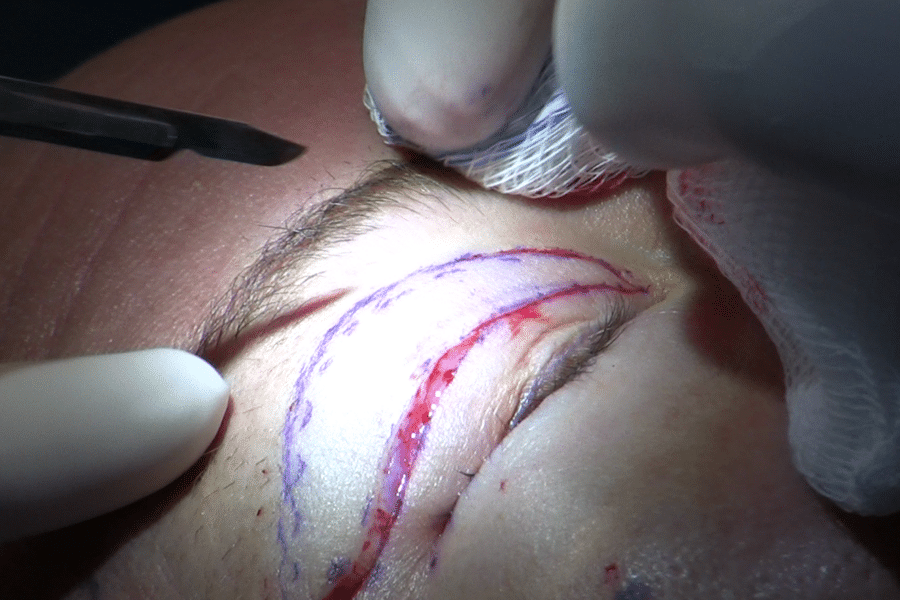 Kankina akių nuovargis ir galvos skausmai? Sužinokite, kaip viena procedūra tai pakeičia visam laikui