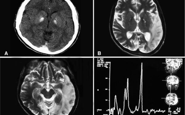 10 000 smegenų skenavimas atskleidė šokiruojančią paslaptį: štai tikroji priežastis, kodėl senstant blogėja atmintis