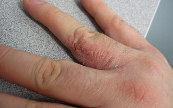 Kodėl stresas tiesiogiai gadina odą? Mokslas rado grandinę, kuri sukelia egzemos protrūkius