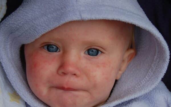 Užfiksuotas kritimas, tačiau grėsmė išlieka: ekspertai ragina nenumoti ranka į šią ligą