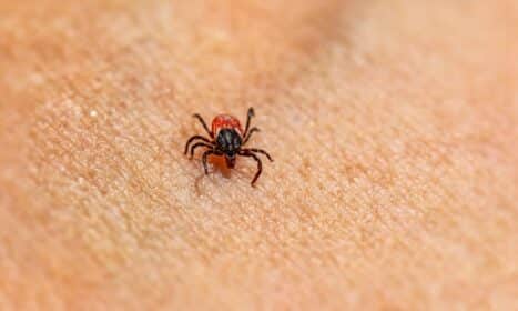 Macro shot of a small tick on human skin. Parasite detail highlighted.