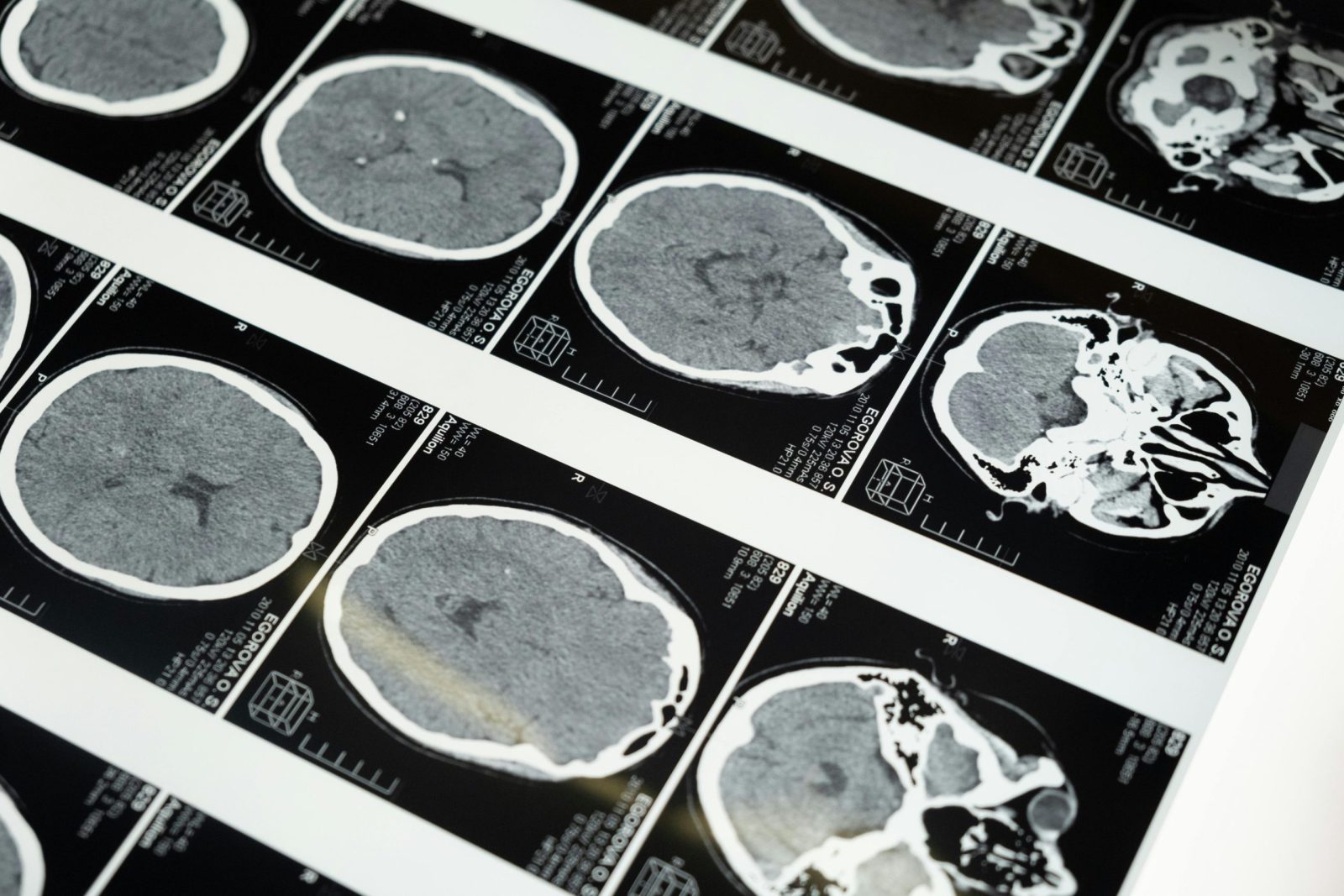 Ar įmanoma išvengti demencijos? Mokslininkai atrado būdą, kaip atkurti sveiką kraujotaką