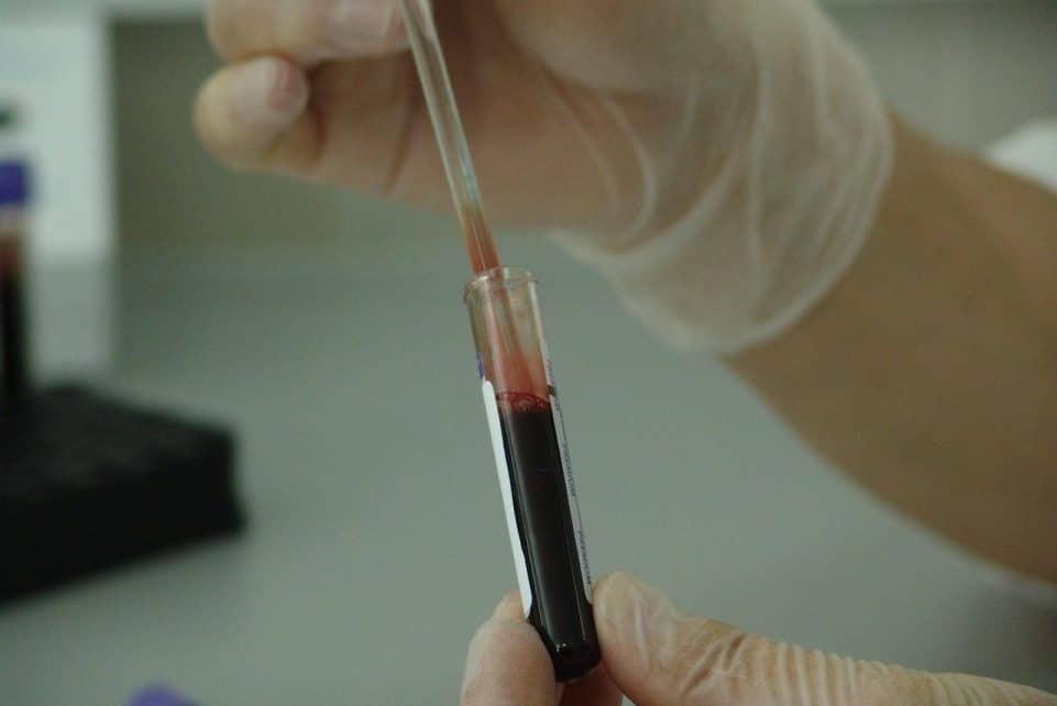 vial, analysis, laboratory, test, medical, medicine, science, lab, experiment, health, disease, tube, sample, hospital, scientific, biology, equipment, healthcare, doctor, research, liquid, virus, scientist, illness, cell, biochemistry, pharmaceutical, diagnosis, chemistry, microbiology, specimen, plasma, ampule, cells, biotechnology, immunology, dna, genetic, immune, cancer, aids, treatment, diagnose