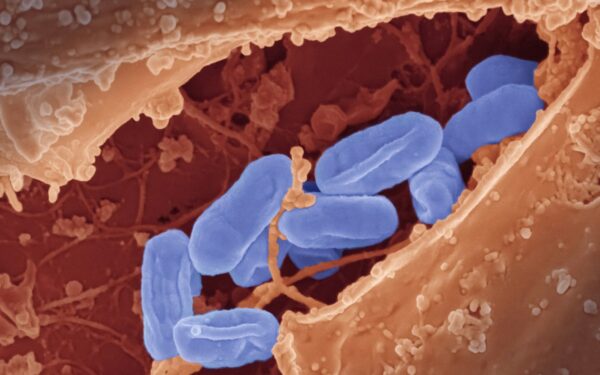 Antibiotikai tampa bejėgiai: štai kokia užmiršta liga vėl kelia didelį pavojų jūsų sveikatai