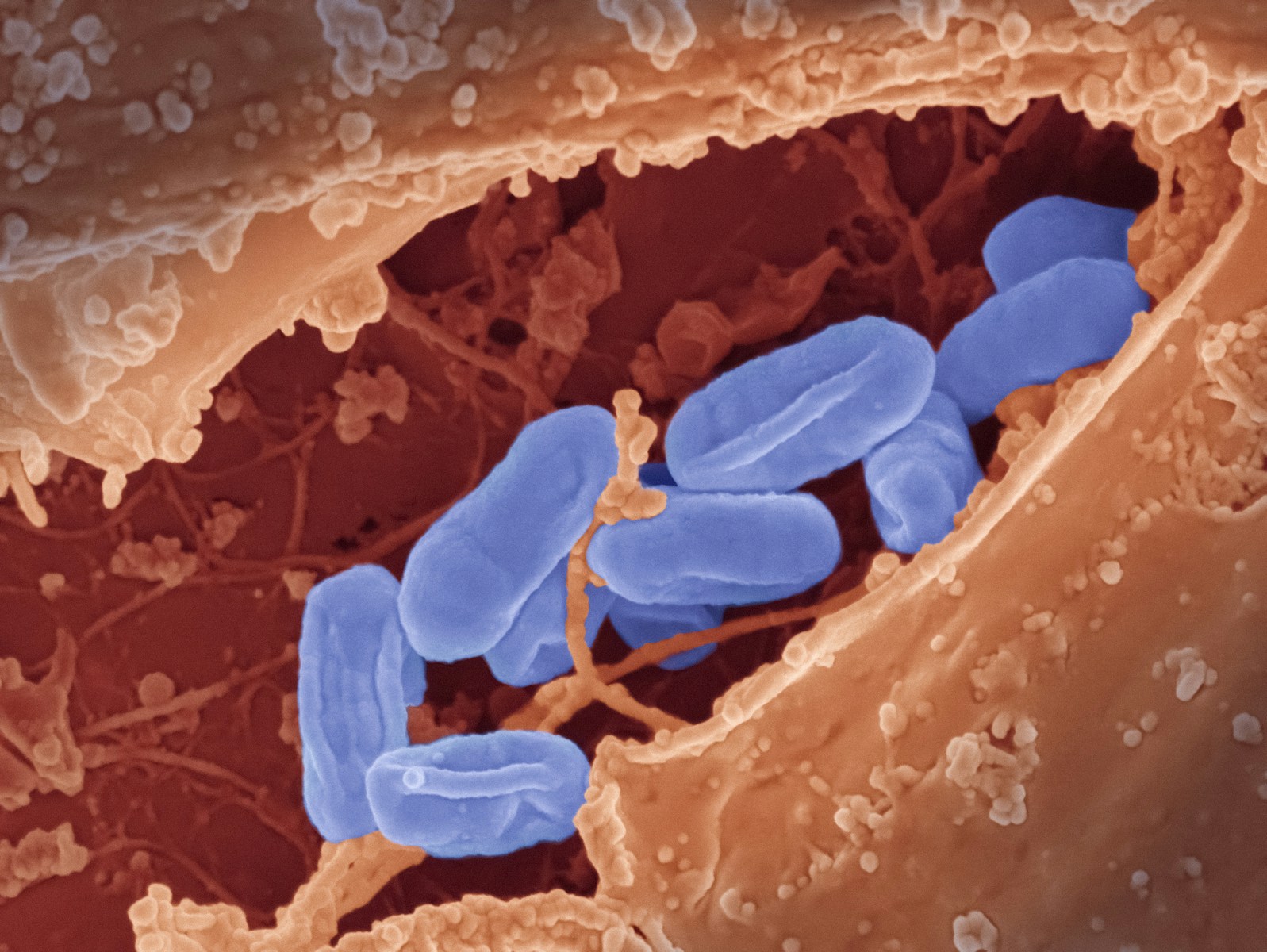 Antibiotikai tampa bejėgiai: štai kokia užmiršta liga vėl kelia didelį pavojų jūsų sveikatai