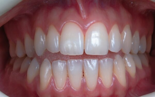 Kodėl vyrai dėl dantų kenčia labiau? Delsimas taisyti dantis gali sukelti net insultą