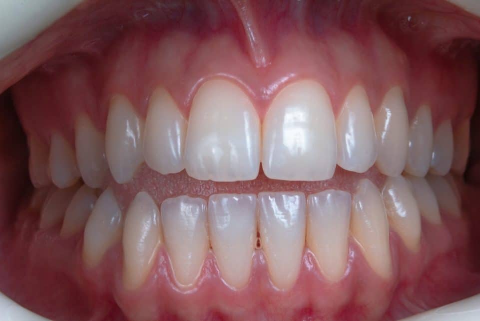 a person's mouth with teeth