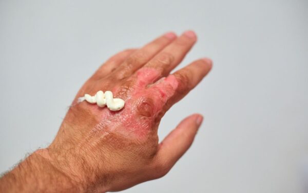 Klaida, kurią daro daugelis: štai kaip iš tiesų vėsinti nudegimą, kad oda gytų greičiau