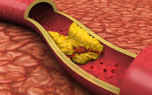 JAV kardiologai paskelbė naujas cholesterolio gaires: ką būtina žinoti, kad apsisaugotumėte