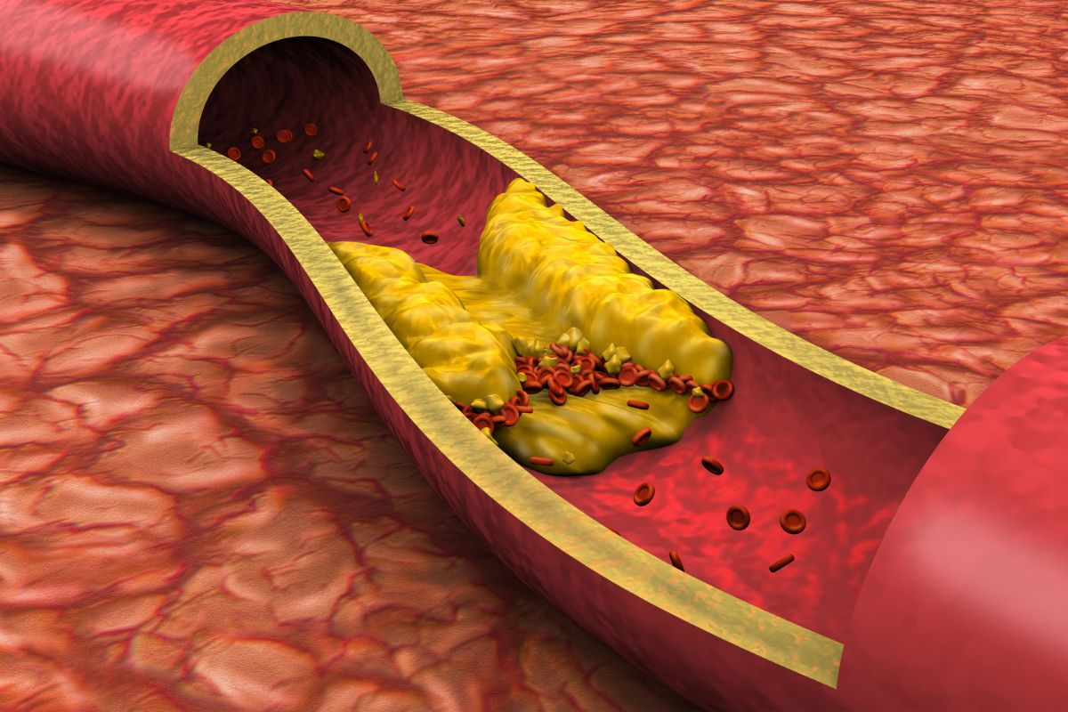 JAV kardiologai paskelbė naujas cholesterolio gaires: ką būtina žinoti, kad apsisaugotumėte