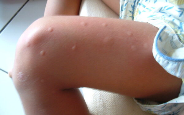 Vargina erkės ir uodai? Paprastas būdas, kaip pasigaminti pigų repelentą, kurio jie tiesiog nepakenčia