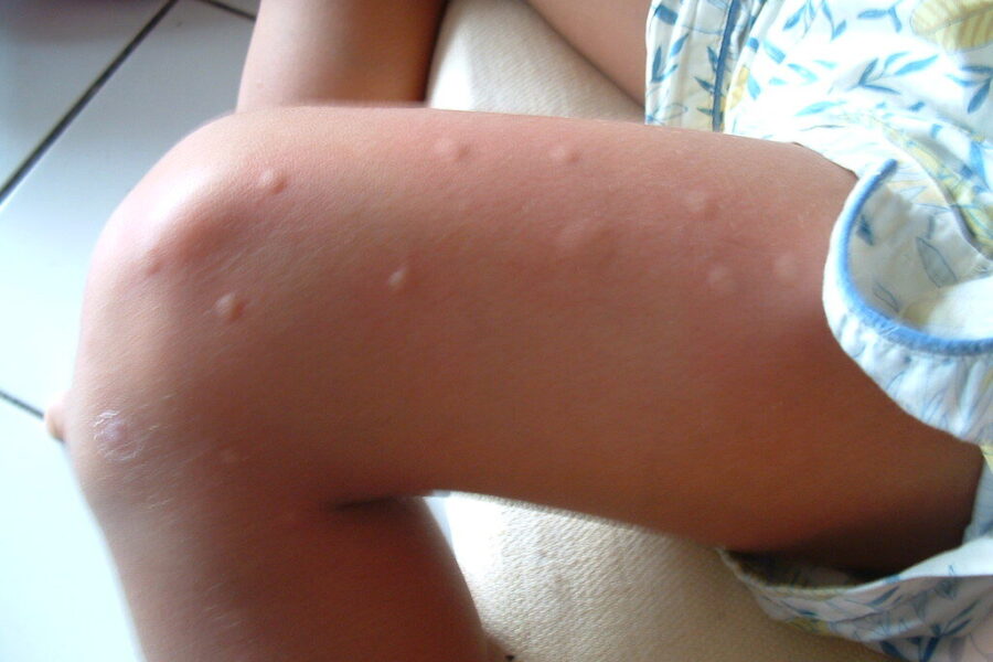 Vargina erkės ir uodai? Paprastas būdas, kaip pasigaminti pigų repelentą, kurio jie tiesiog nepakenčia