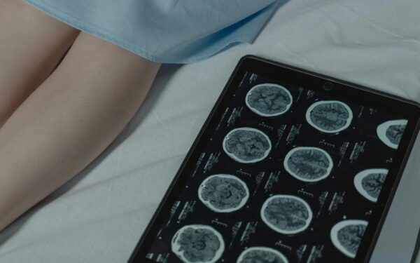 „Tai blogiau už mirtį“: mokslininkai atskleidė sukrečiančią tiesą apie lėtinio nuovargio sindromą