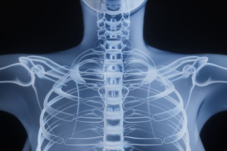 X-ray of a human torso and shoulders