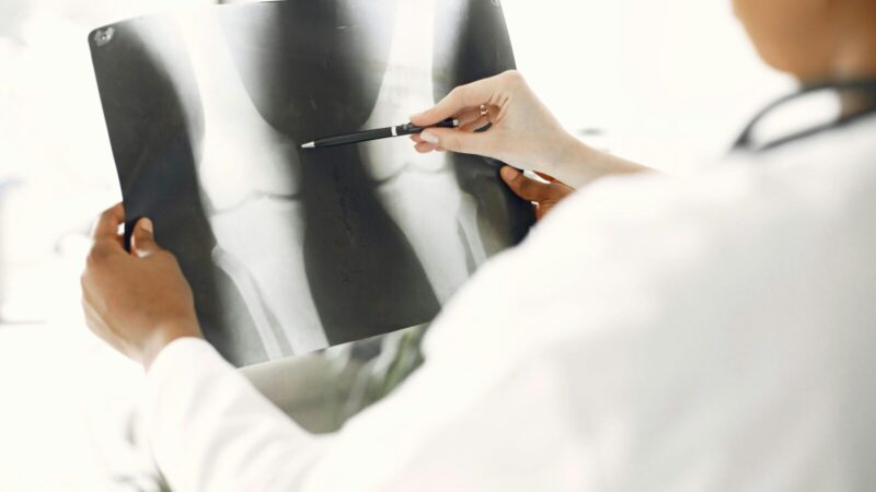 Osteoporozė diagnozuojama vis jaunesniems: gydytojai perspėja, ko nereikėtų ignoruoti