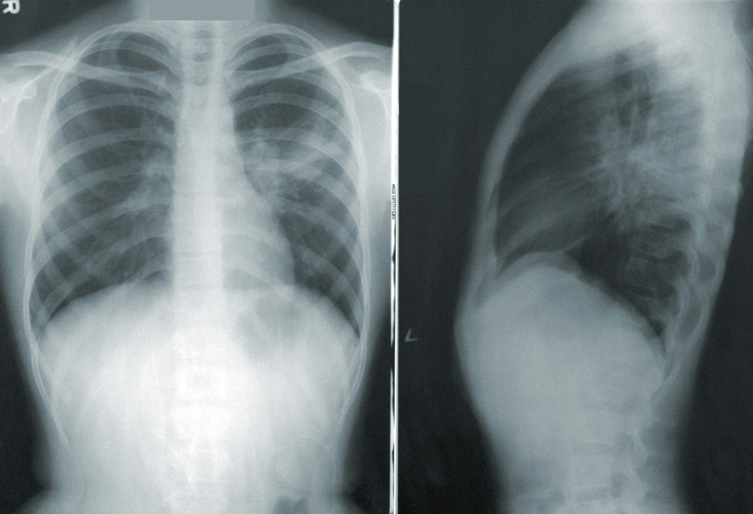 Pavojinga plaučių infekcija gali smogti kiekvienam: gydytojai įspėja, kada delsti jau nebegalima